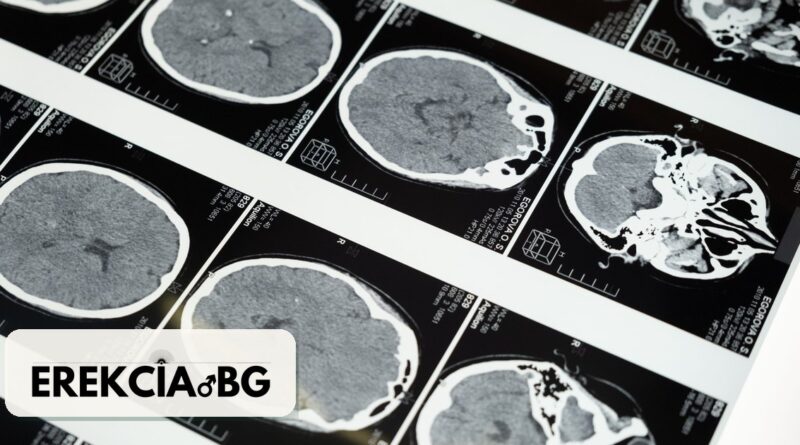 Множествена склероза и ЕД